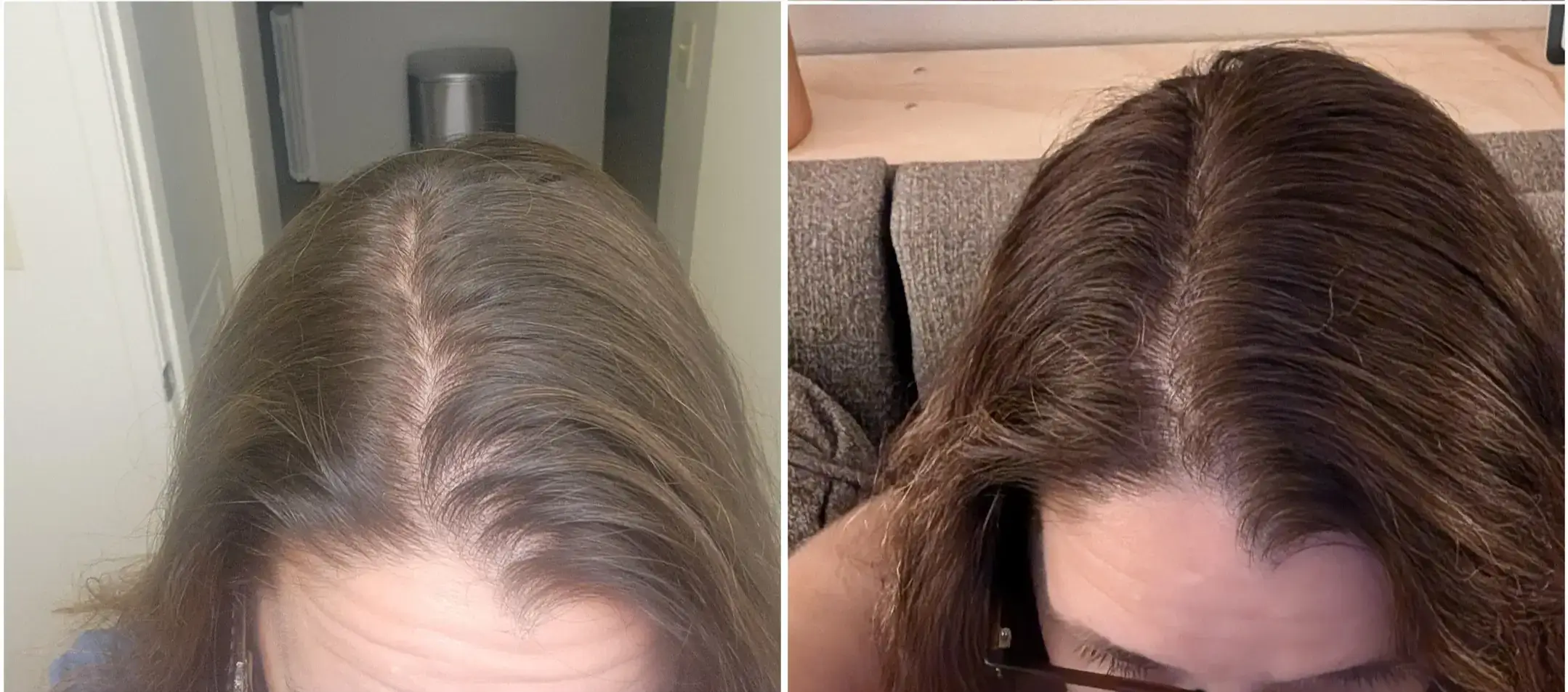 Resultado da Fernanda — cabelo crescendo depois do parto com H-Regrow