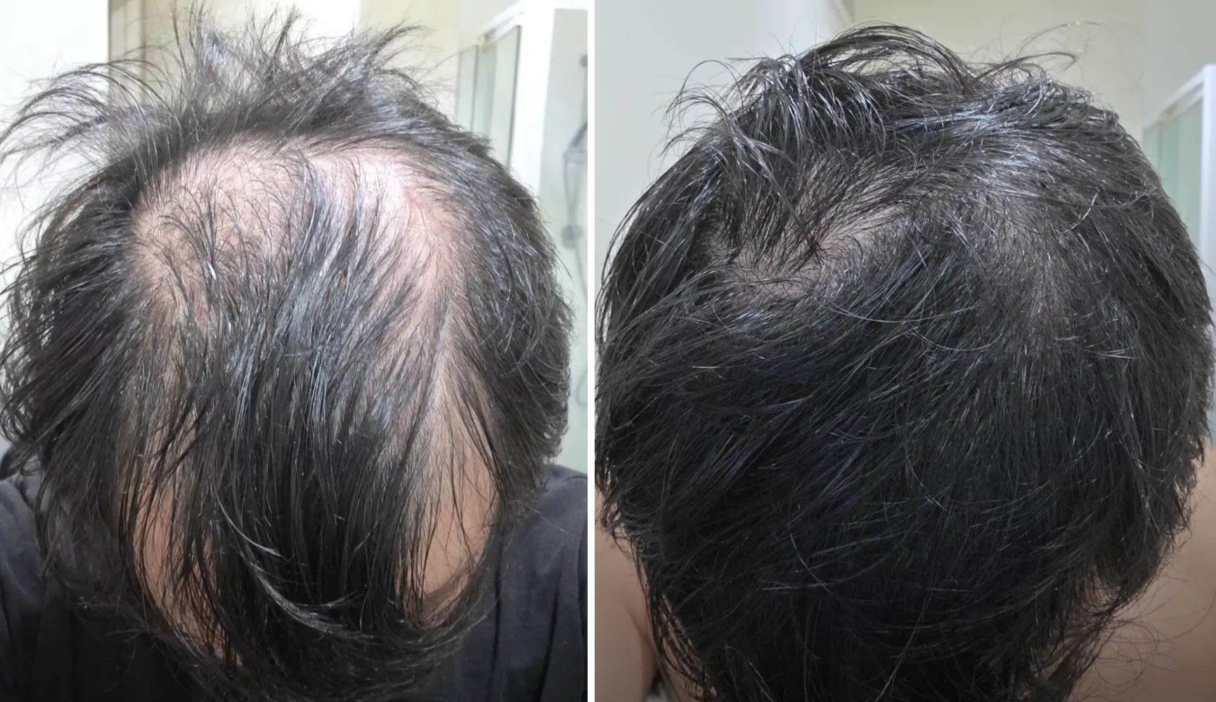 Resultado do Flávio — cabelo de volta depois do H-Regrow
