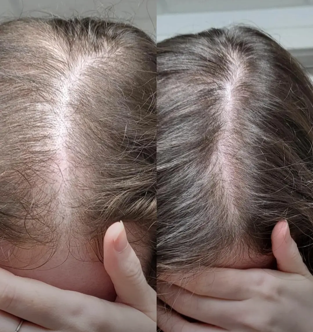 Resultado da Gláucia — cabelo recuperado após a queda pós-parto com H-Regrow