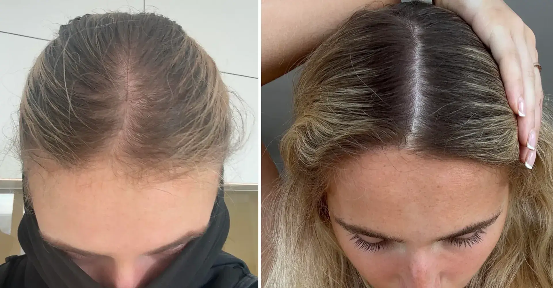 Resultado da Sofia — cabelo saudável e cheio de novo com H-Regrow