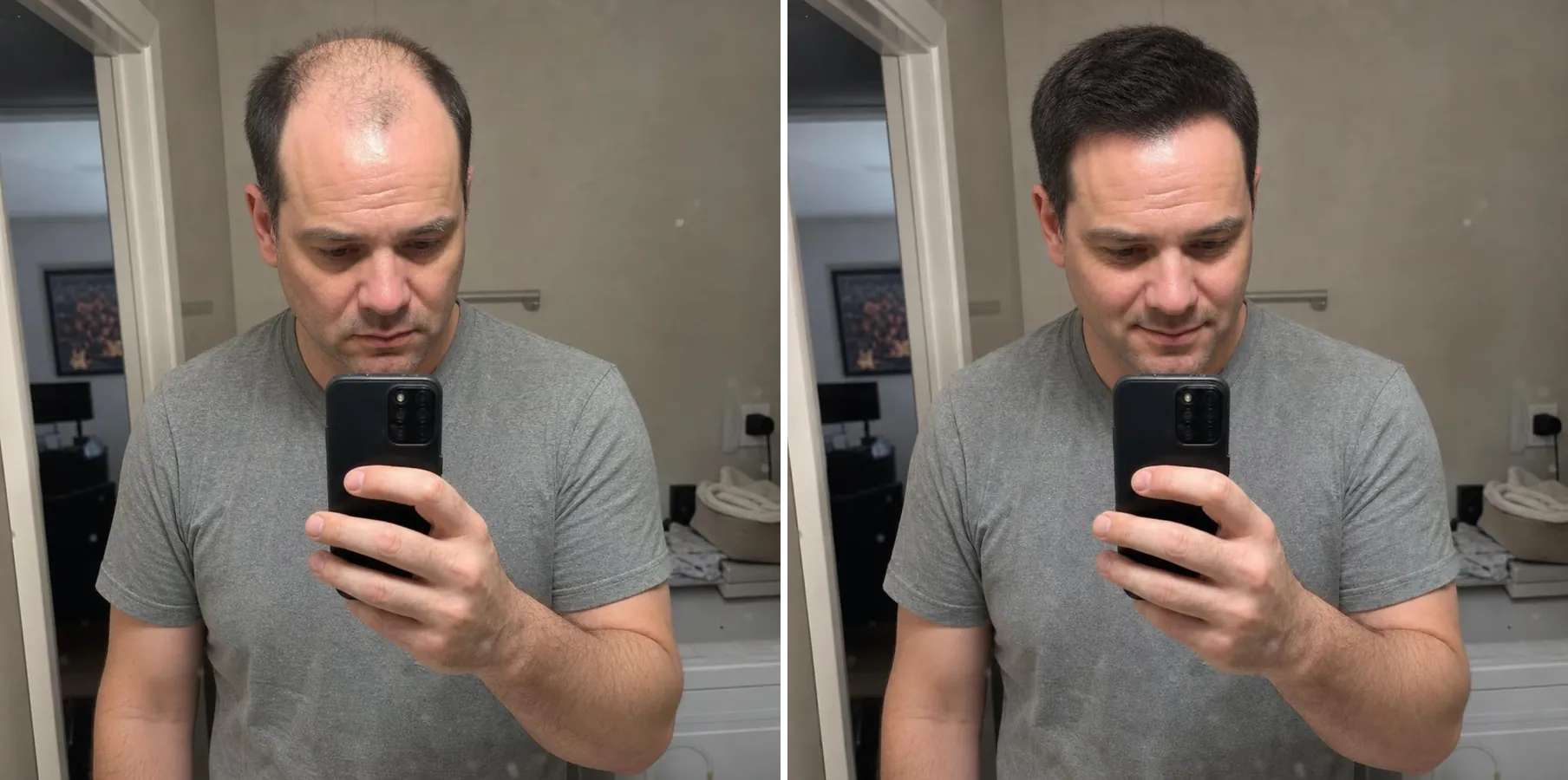 Antes e depois real — fios fortes e sem queda após tratamento com H-Regrow