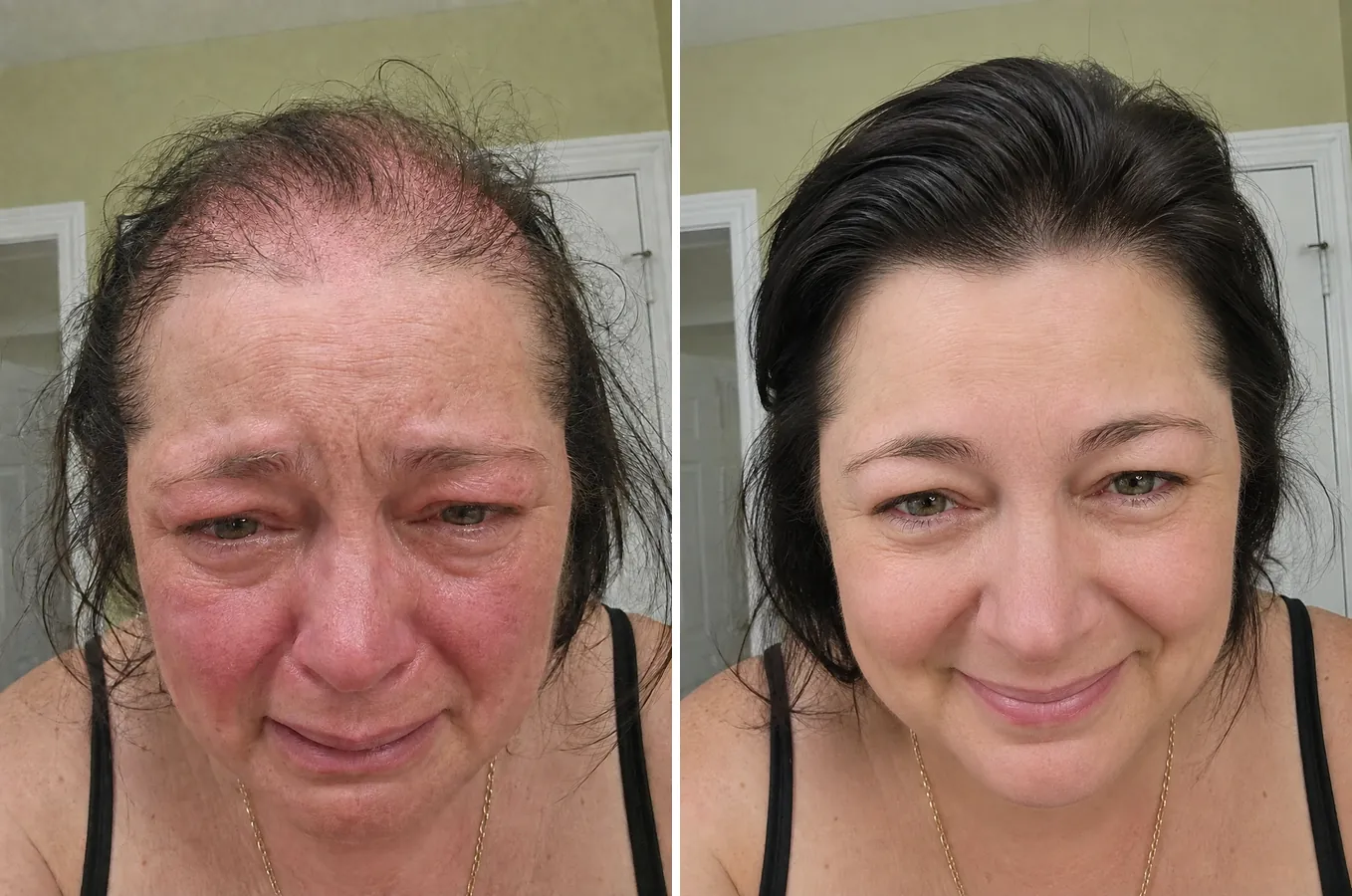 Antes e depois da Rosana — recuperação total do couro cabeludo após o estrago do laser